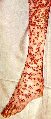 Early Smallpox Pustules